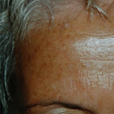 pigmentation