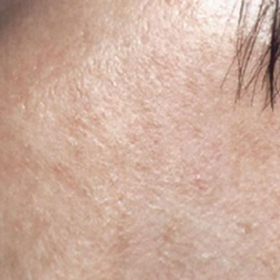 treatment for pigmentation