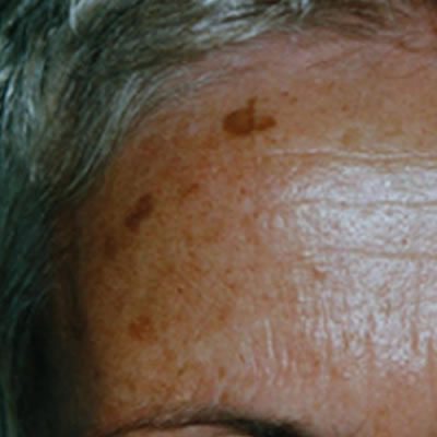 pigment removal