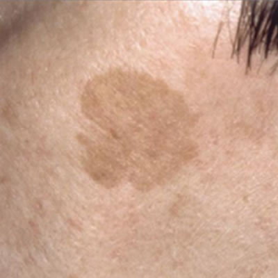 pigmentation removal