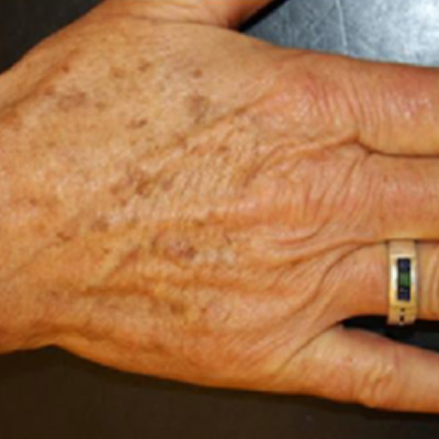 pigmentation removal
