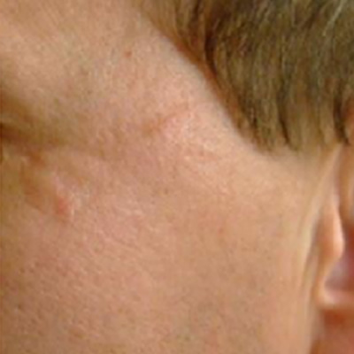 scar removals