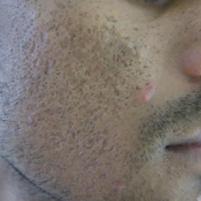 scar treatment