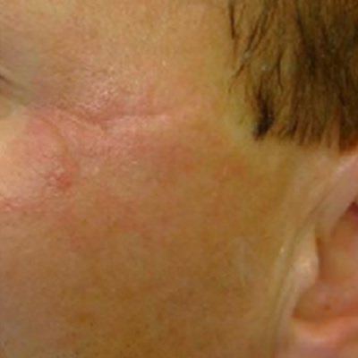 blemish removal