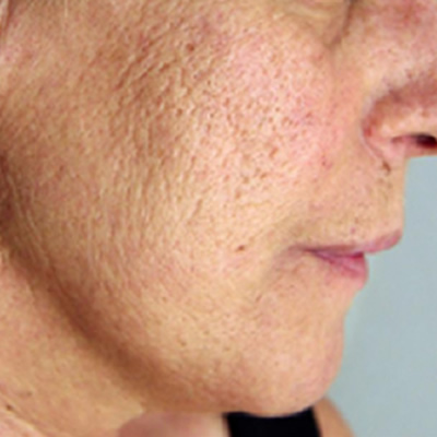 removal of scars