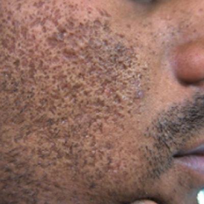 scar removal