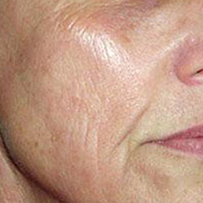 skin rejuvenation treatment