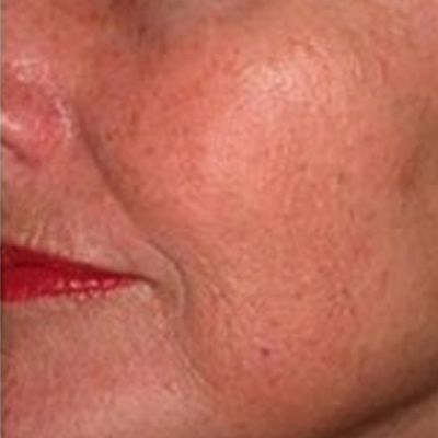 treatment for wrinkles