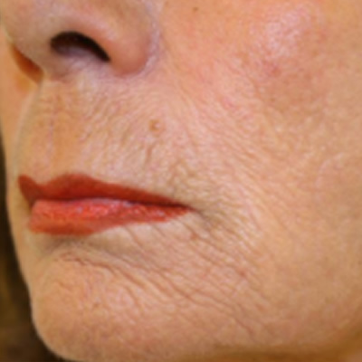 skin resurfacing treatment