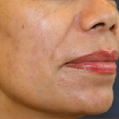 skin resurfacing treatment
