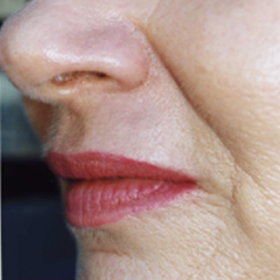 skin resurfacing