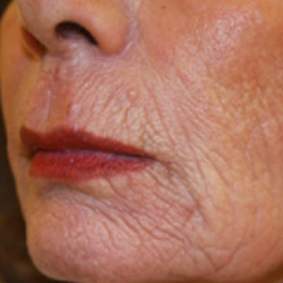 skin resurfacing durban