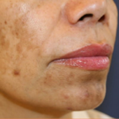 resurfacing skin