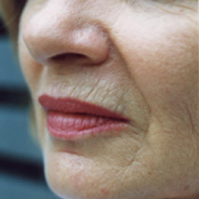 skin resurfacing