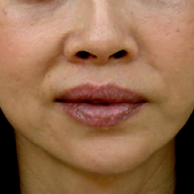 skin whitening treatment