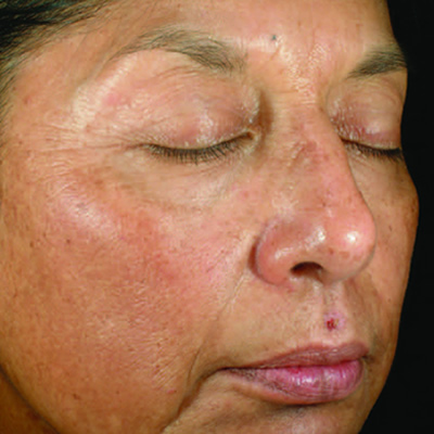 skin whitening