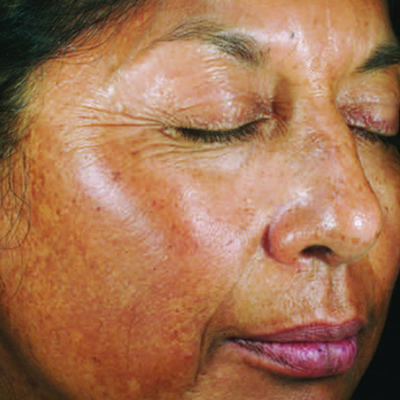 skin whitening