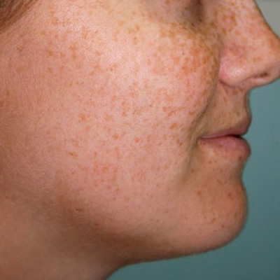 skin whitening treatments