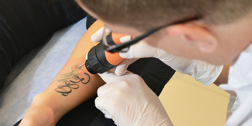 remove tattoos