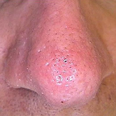 removal of veins