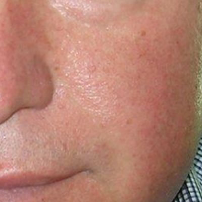 vein removal durban