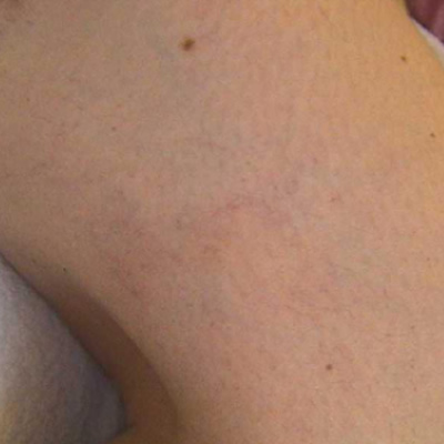vein removal treatments