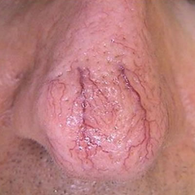 vein removal treatment