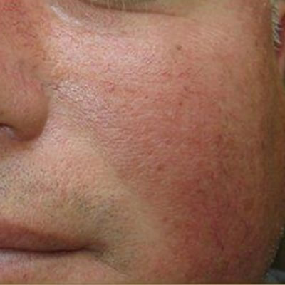 vein removal treatment