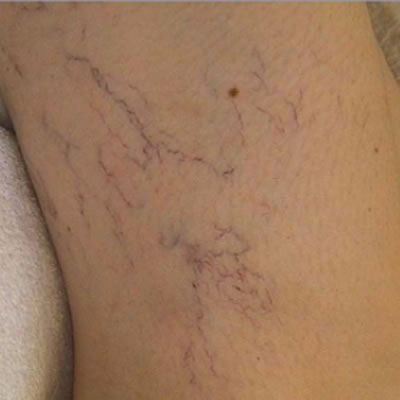 veins