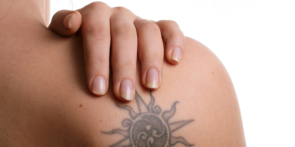tattoo removal