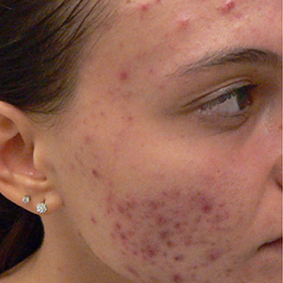 acne treatment scaring